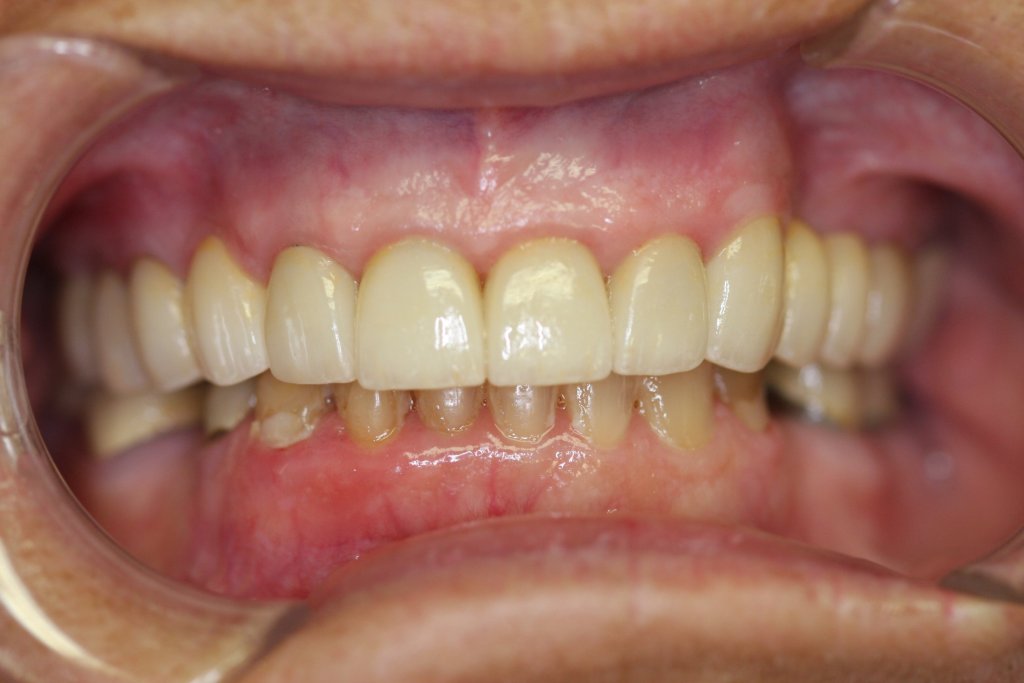 Case Study 2 After Photo with Porcelain Crowns