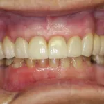 Case Study 2 After Photo with Porcelain Crowns