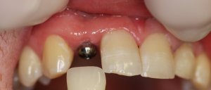 Individual Tooth Before Photo