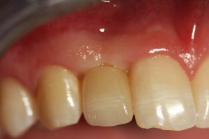 Individual Tooth After Photo